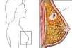 Identifying the Signs of Breast Cancer